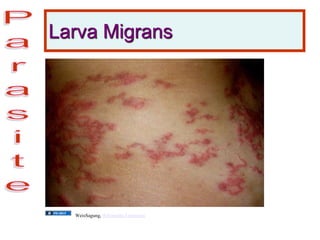 Larva Migrans
WeisSagung, Wikimedia Commons
 