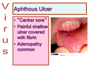 Aphthous Ulcer
• “Canker sore”
• Painful shallow
ulcer covered
with fibrin
• Adenopathy
common
Maksim, Wikimedia Commons
 