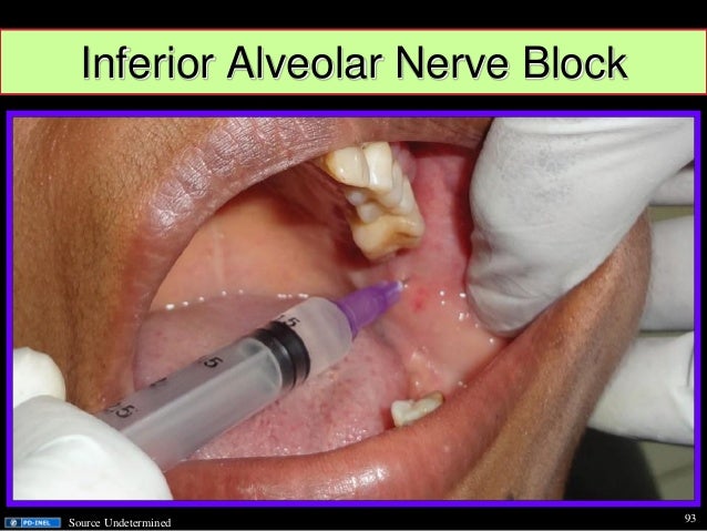 Gemc Dental Emergencies And Common Dental Blocks Resident