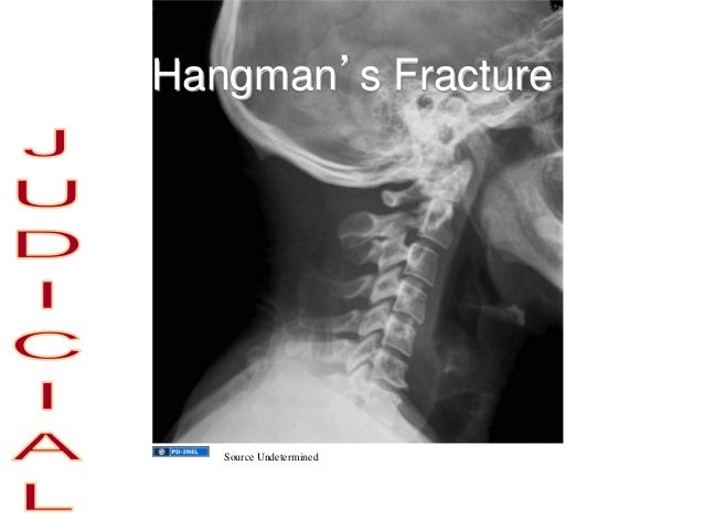 Hanging Injuries And Strangulation: Practice Essentials – IQFDW