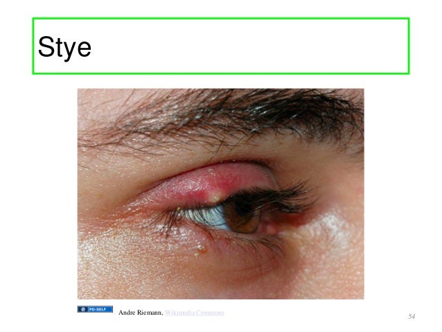 Erythromycin Ophthalmic Ointment For Stye