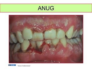 GEMC- Oral and Dental Emergencies: The Patient with a Sore Throat ...