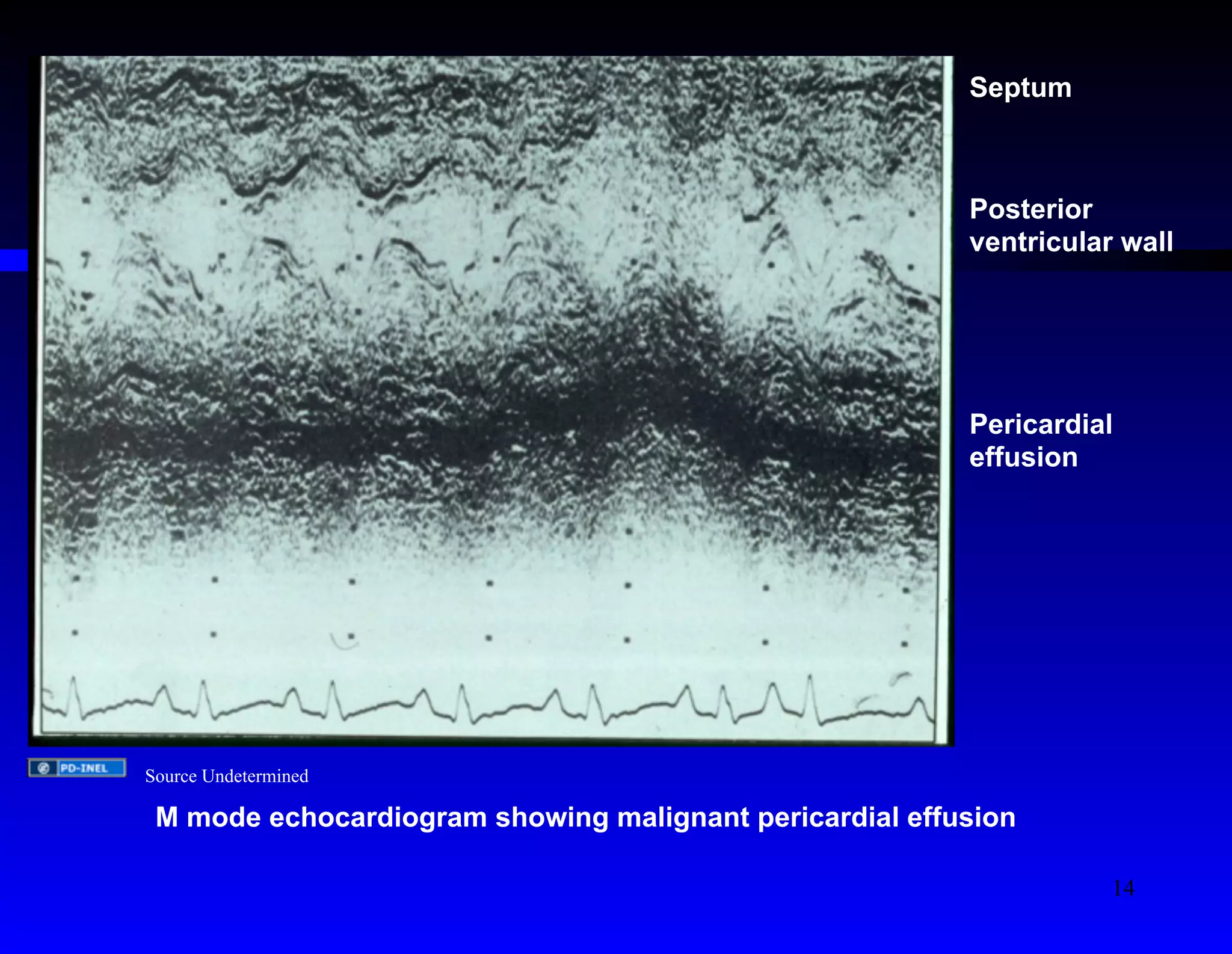 Septum 
Posterior 
ventricular wall 
Pericardial 
effusion 
Source Undetermined 
M mode echocardiogram showing malignant pericardial effusion 
14 
 