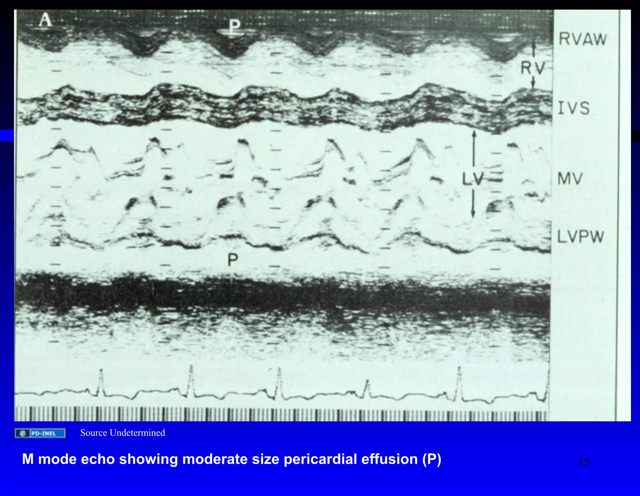 Source Undetermined 
M mode echo showing moderate size pericardial effusion (P) 
15 
 