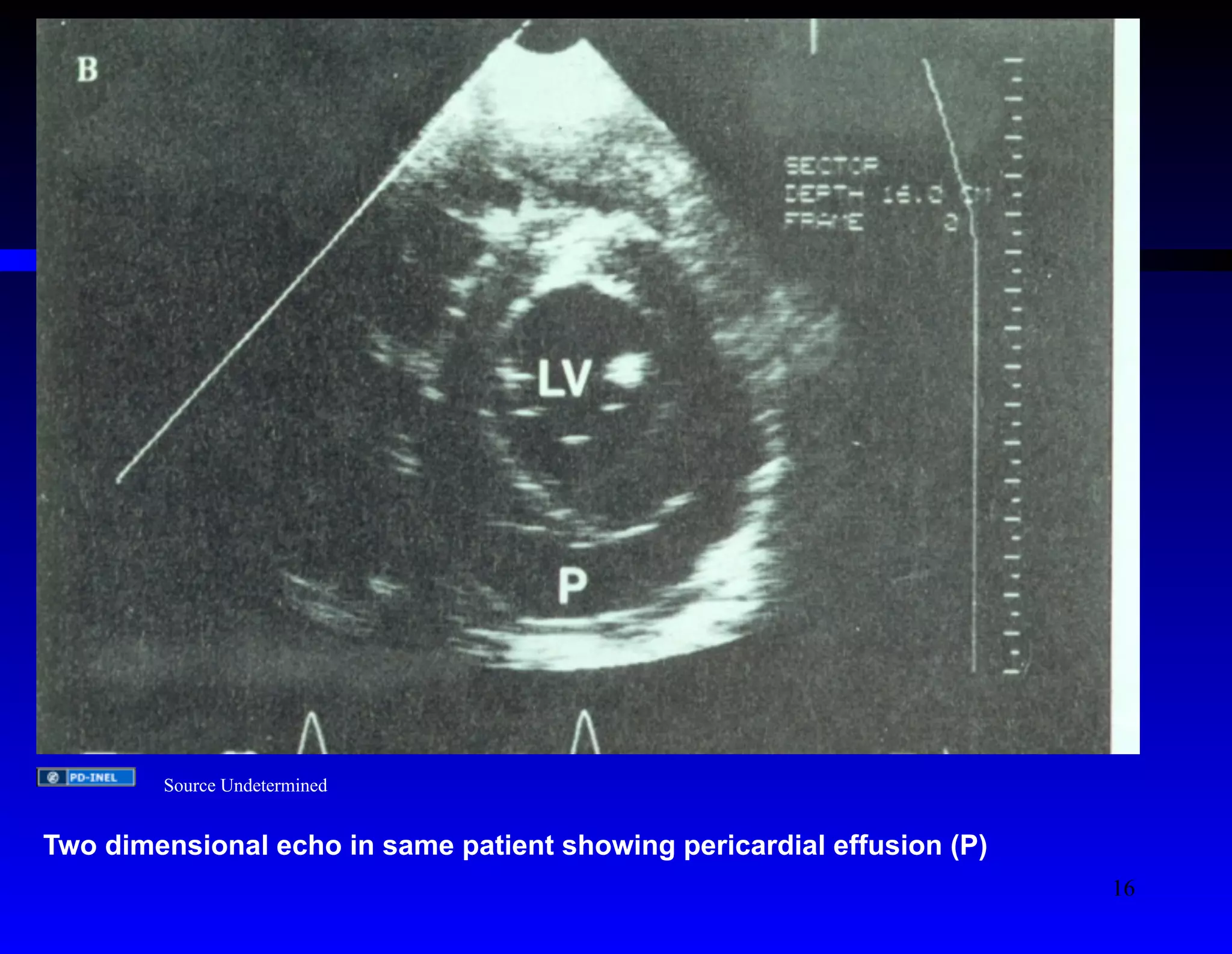 Source Undetermined 
Two dimensional echo in same patient showing pericardial effusion (P) 
16 
 