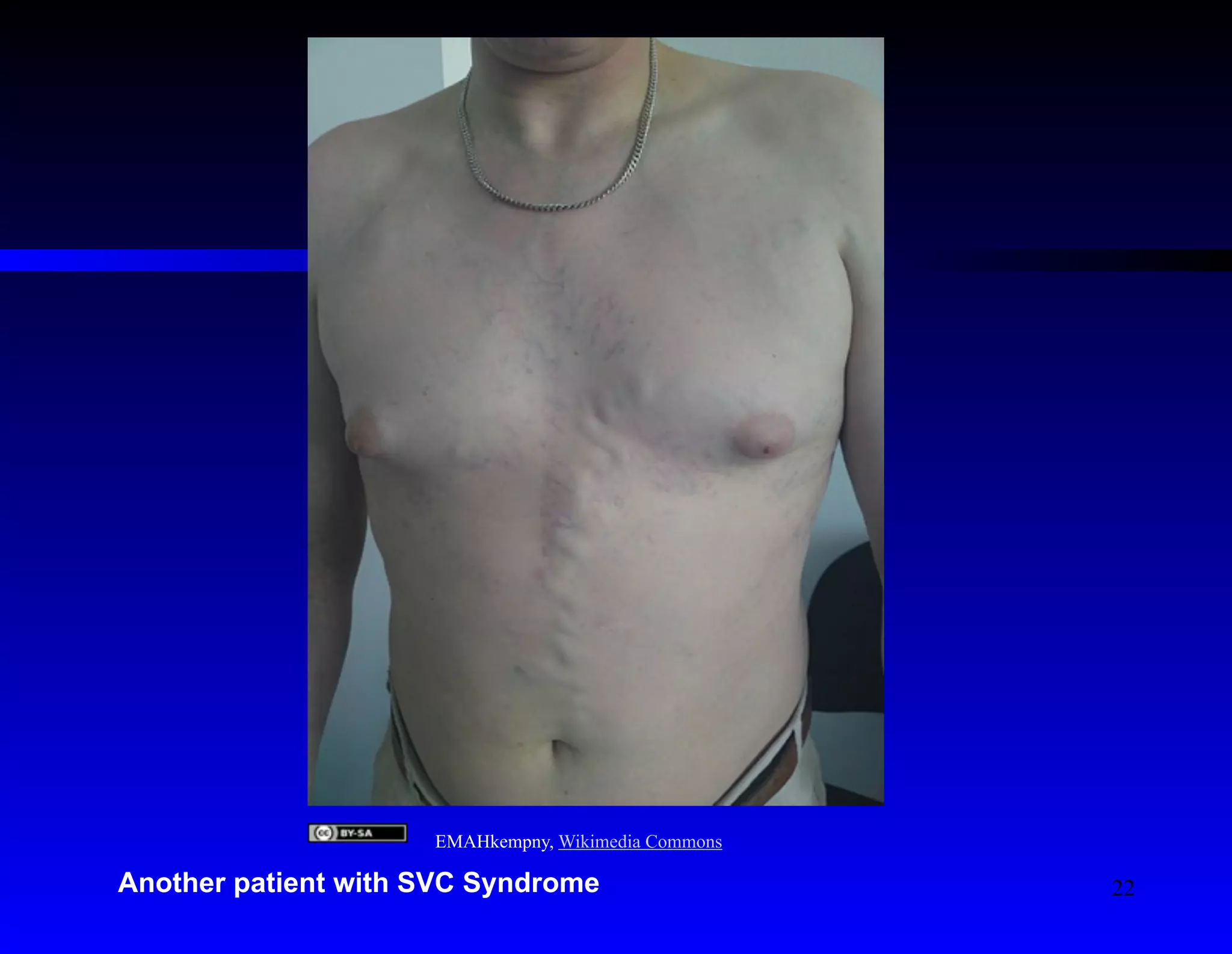 EMAHkempny, Wikimedia Commons 
Another patient with SVC Syndrome 
22 
 