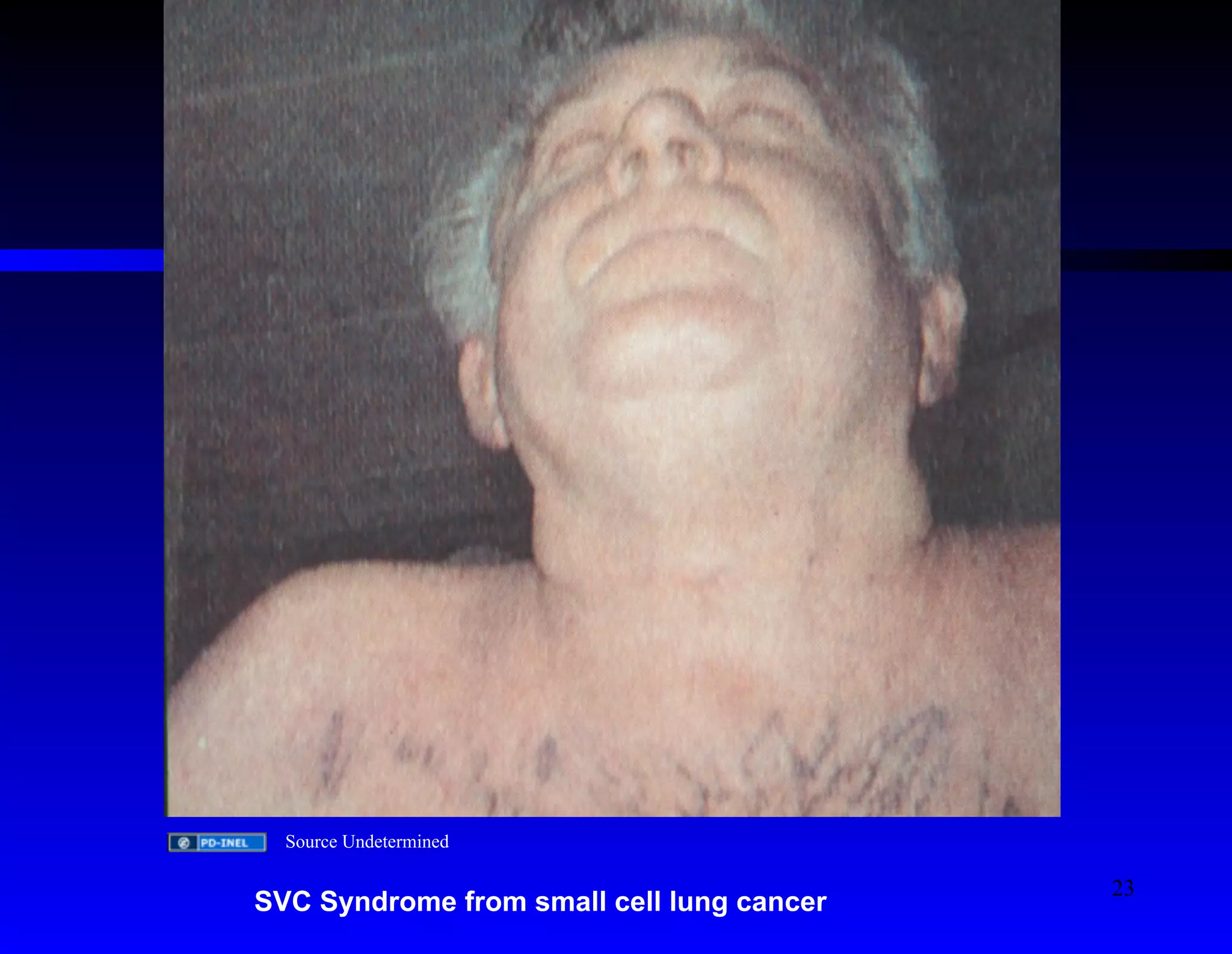 Source Undetermined 
SVC Syndrome from small cell lung cancer 
23 
 