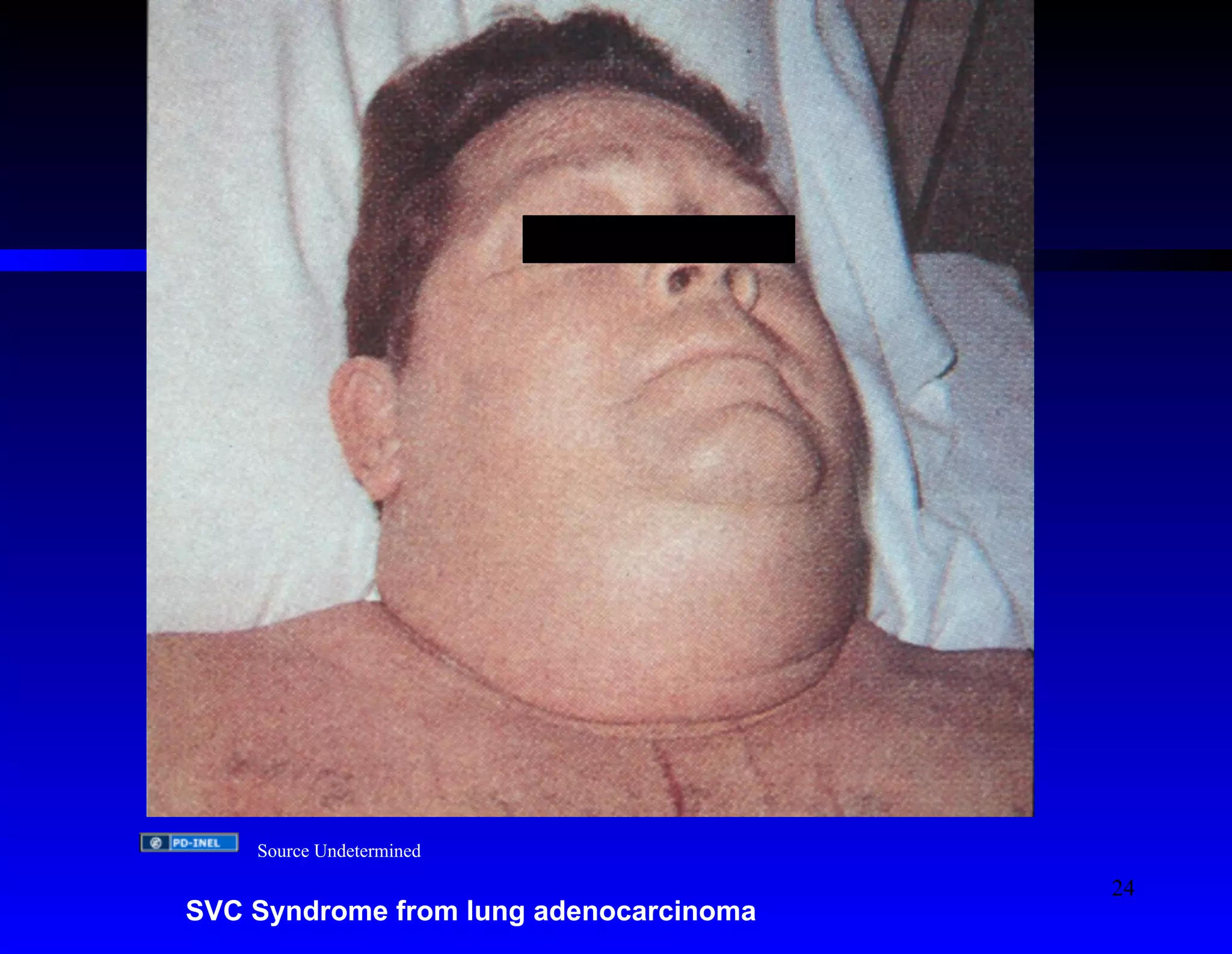 Source Undetermined 
SVC Syndrome from lung adenocarcinoma 
24 
 
