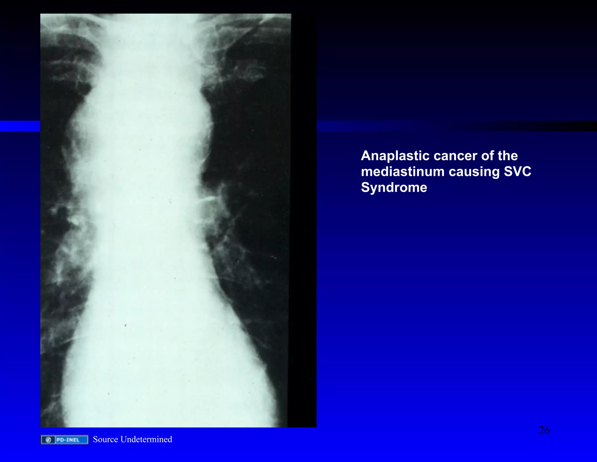 Anaplastic cancer of the 
mediastinum causing SVC 
Syndrome 
Source Undetermined 
26 
 