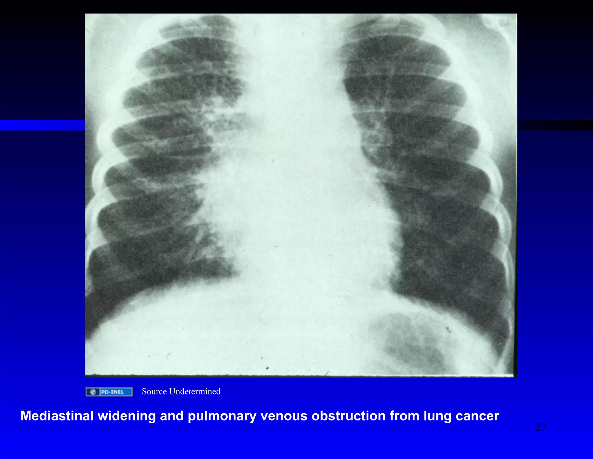 Source Undetermined 
Mediastinal widening and pulmonary venous obstruction from lung cancer 
27 
 