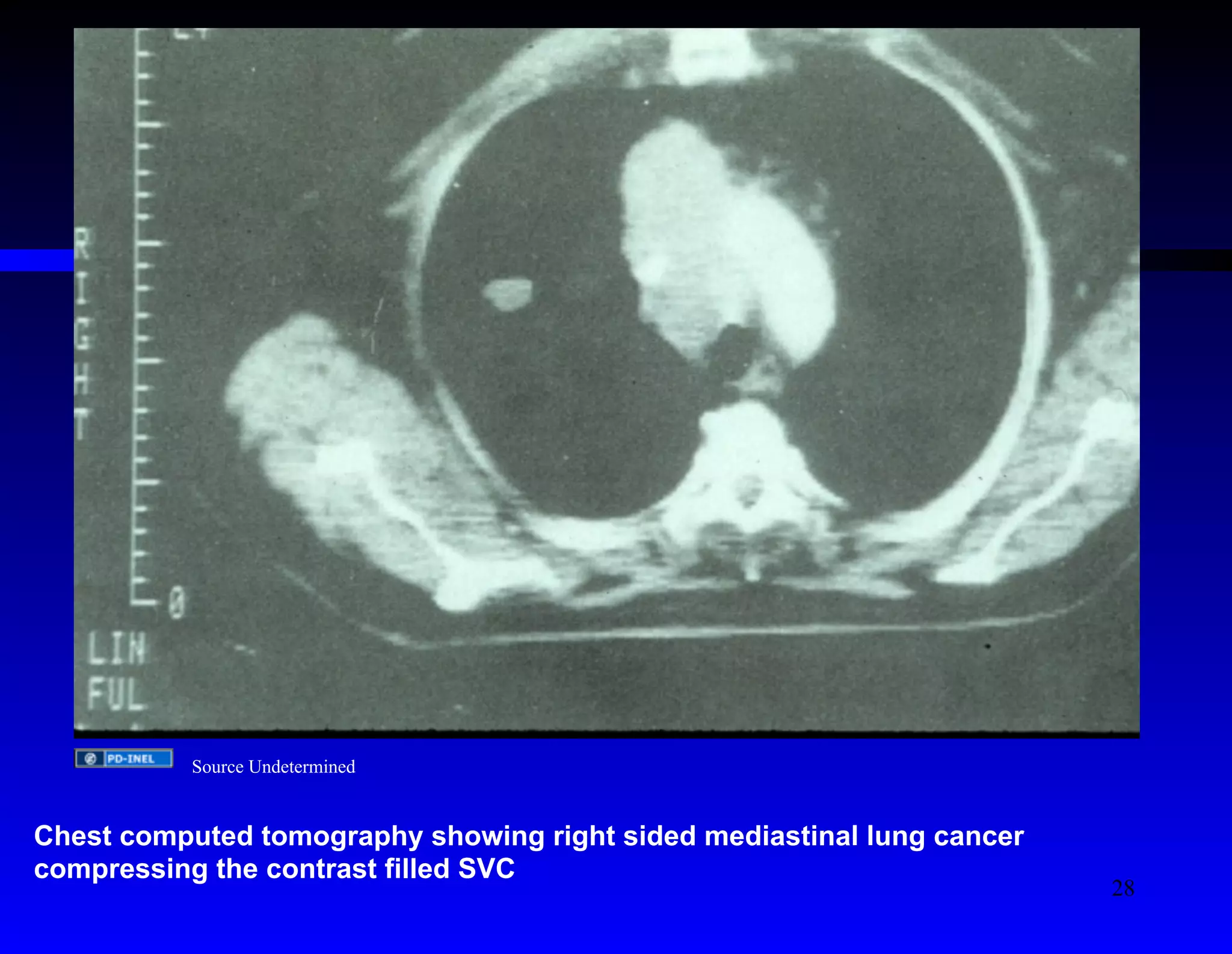 Source Undetermined 
Chest computed tomography showing right sided mediastinal lung cancer 
compressing the contrast filled SVC 
28 
 
