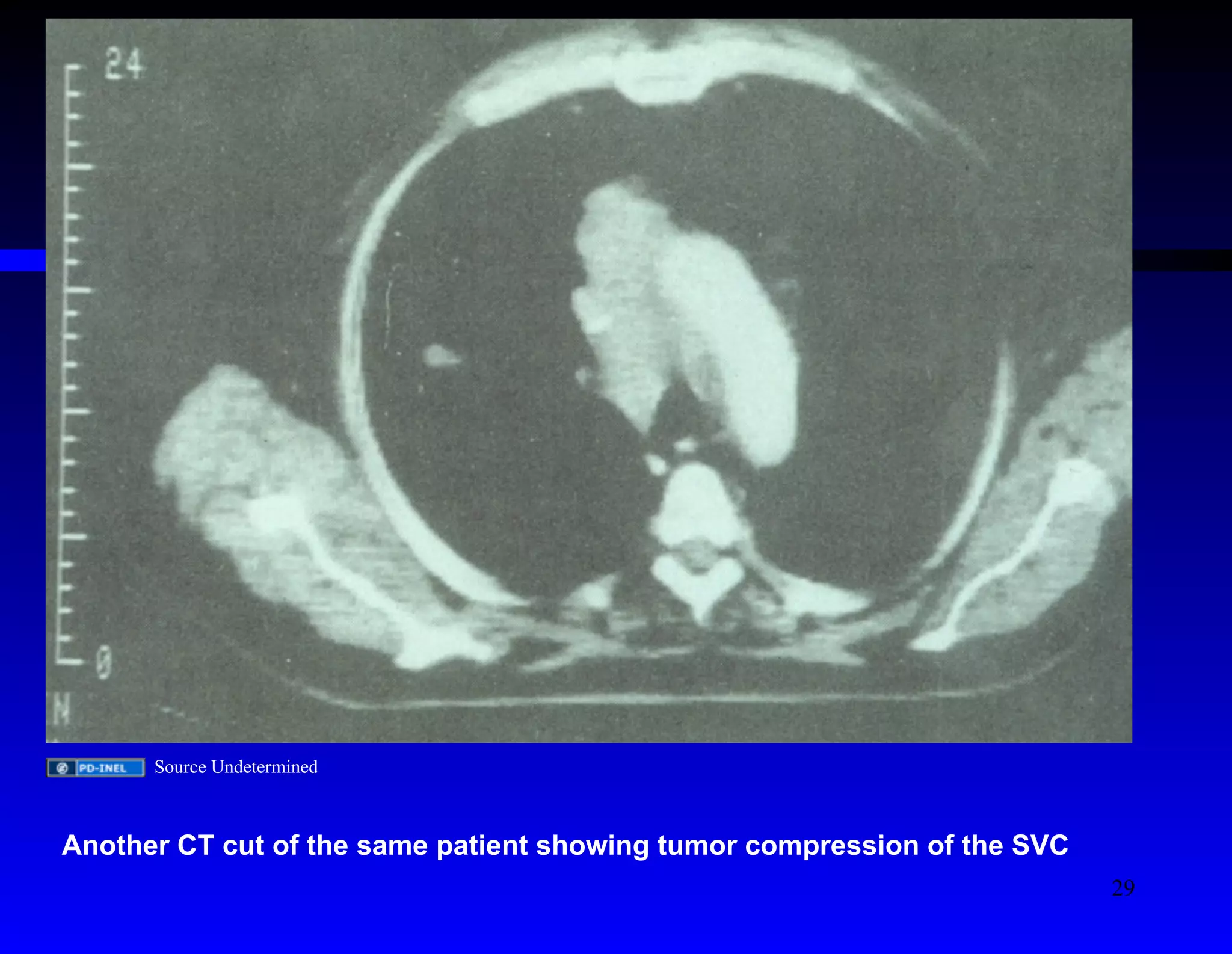 Source Undetermined 
Another CT cut of the same patient showing tumor compression of the SVC 
29 
 