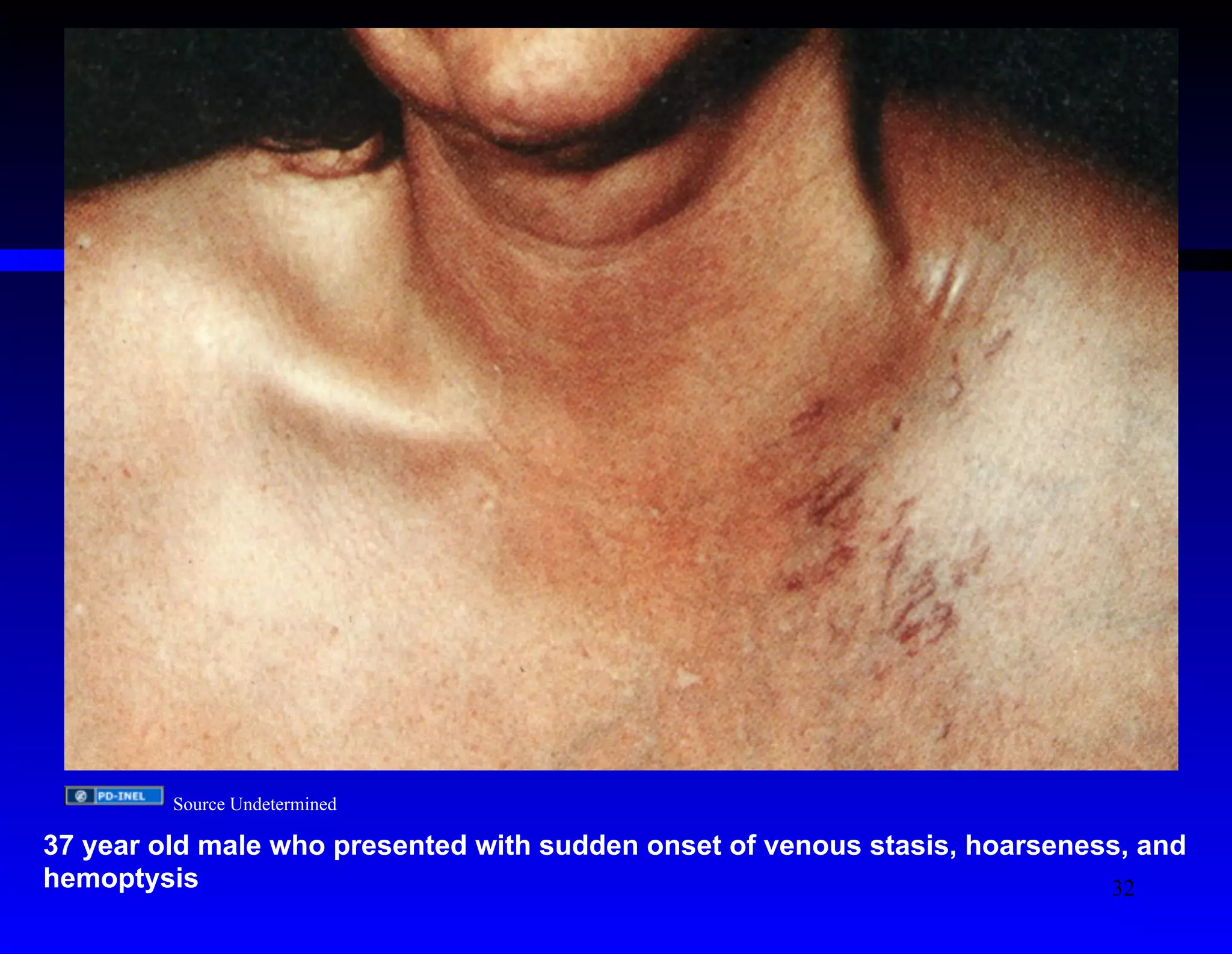 Source Undetermined 
37 year old male who presented with sudden onset of venous stasis, hoarseness, and 
hemoptysis 
32 
 