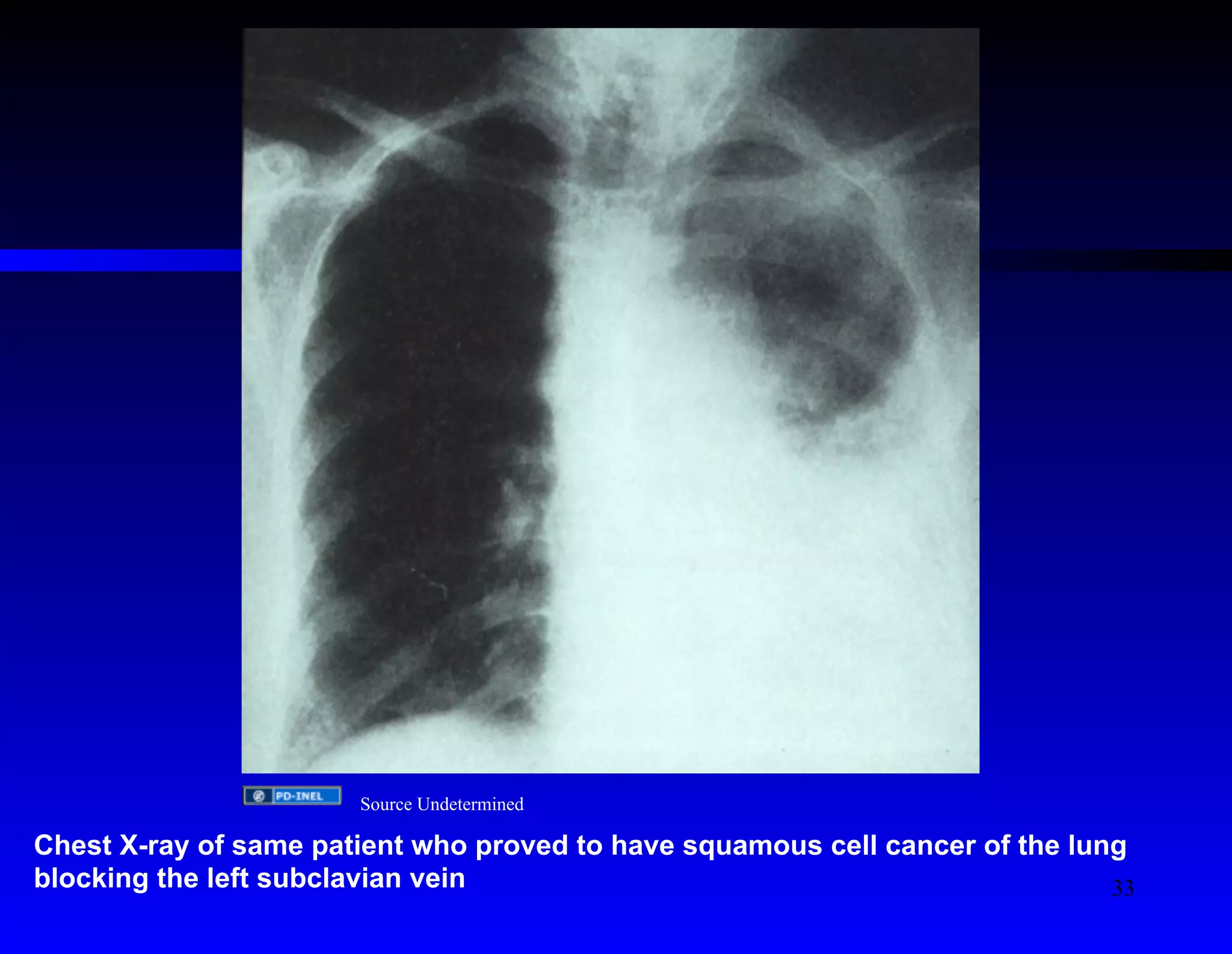 Source Undetermined 
Chest X-ray of same patient who proved to have squamous cell cancer of the lung 
blocking the left subclavian vein 
33 
 