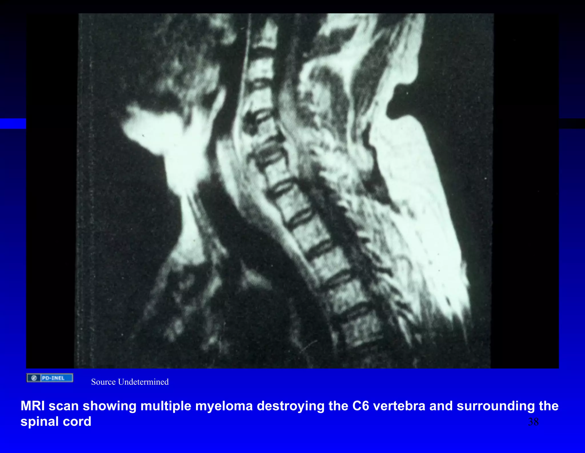 Source Undetermined 
MRI scan showing multiple myeloma destroying the C6 vertebra and surrounding the 
spinal cord 
38 
 