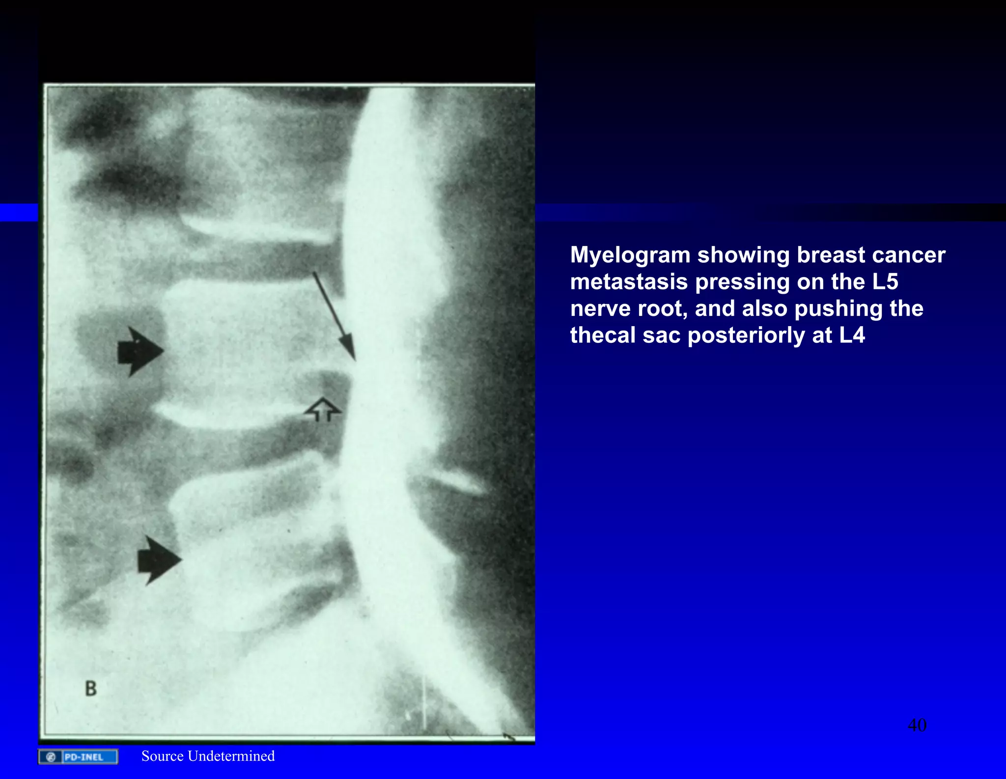 Myelogram showing breast cancer 
metastasis pressing on the L5 
nerve root, and also pushing the 
thecal sac posteriorly at L4 
Source Undetermined 
40 
 