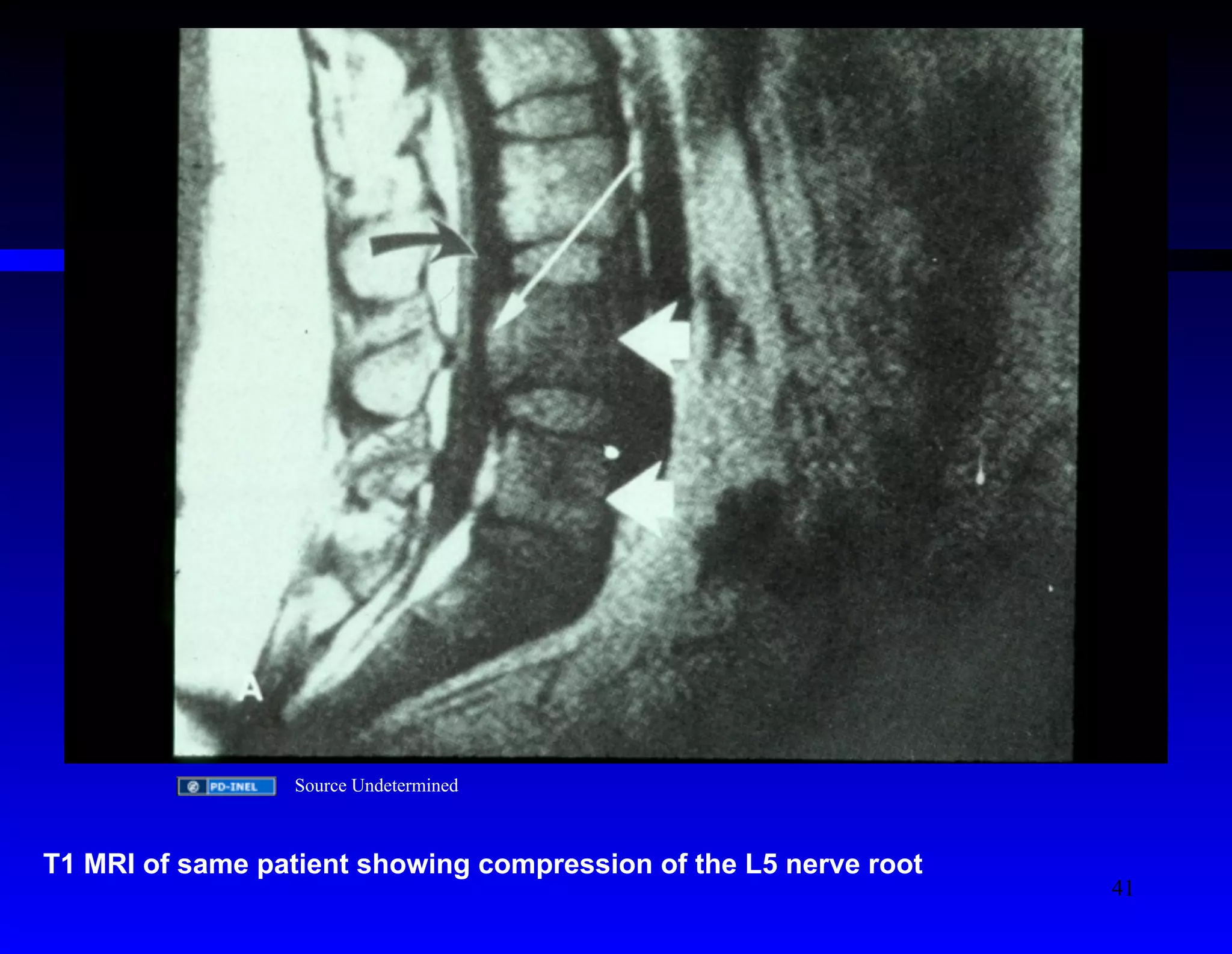 Source Undetermined 
T1 MRI of same patient showing compression of the L5 nerve root 
41 
 