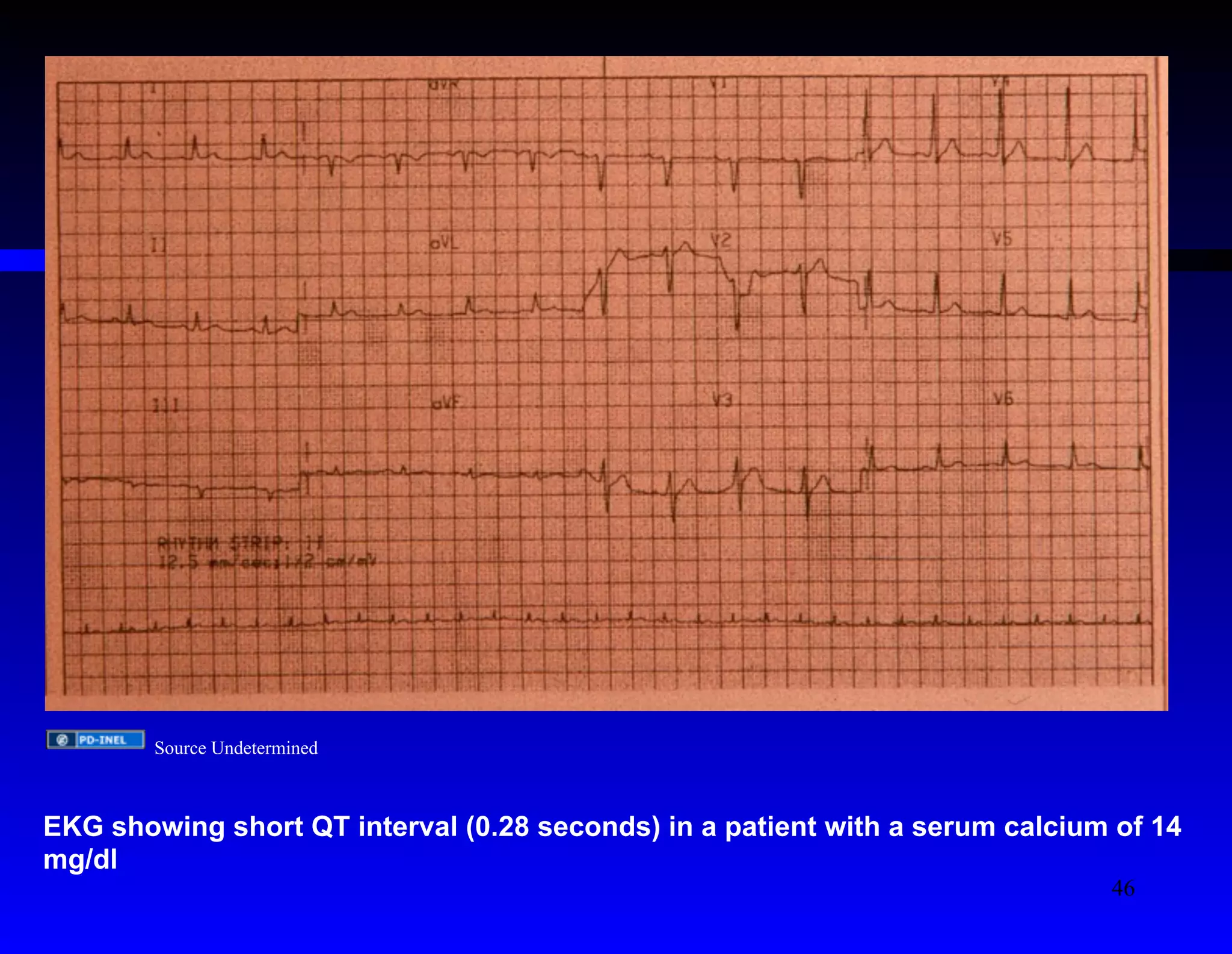 Source Undetermined 
EKG showing short QT interval (0.28 seconds) in a patient with a serum calcium of 14 
mg/dl 
46 
 