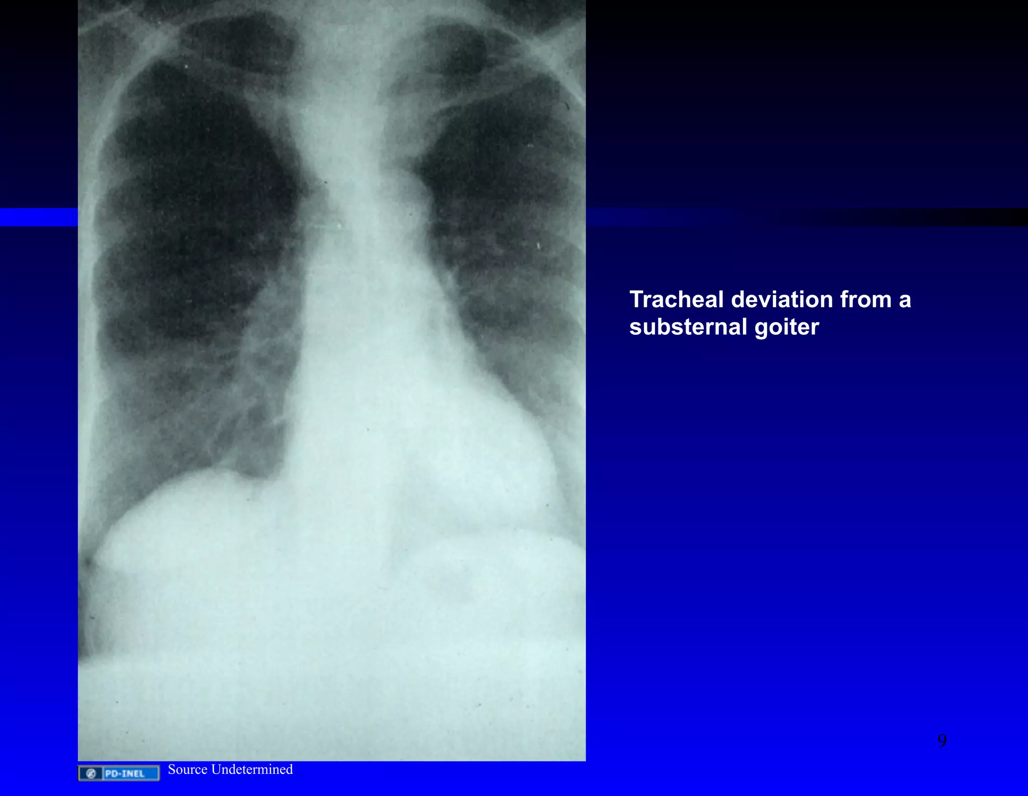 Tracheal deviation from a 
substernal goiter 
Source Undetermined 
9 
 