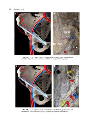 Fig. 15. (a,b) Type II, which crosses below the EIA. [Color ﬁgure can be
viewed in the online issue, which is available at wileyonlinelibrary.com.]
Fig. 16. (a,b) Type III, which anastomoses with the SCIV. [Color ﬁgure can
be viewed in the online issue, which is available at wileyonlinelibrary.com.]
10 Ghassemi et al.
 