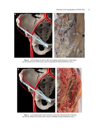 Fig. 6. (a,b) Subtype Ie with no AB, but multiple small branches. [Color ﬁgure
can be viewed in the online issue, which is available at wileyonlinelibrary.com.]
Fig. 7. (a,b) Type II with a short common trunk of the HB and the AB. [Color ﬁg-
ure can be viewed in the online issue, which is available at wileyonlinelibrary.com.]
5Anatomy and Topography of DCIA Flap
 