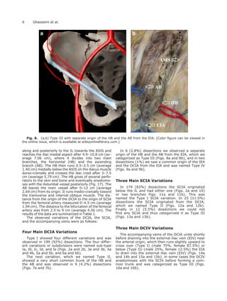 along and posteriorly to the IL towards the ASIS and
reaches the iliac medial aspect after 4.9–10.8 cm (av-
erage 7.06 cm), where it divides into two main
branches, the horizontal (HB) and the ascending
branch (AB). The HB then runs 0.5–2.5 cm (average
1.40 cm) medially below the ASIS on the iliacus muscle
dorso-cranially and crosses the iliac crest after 3–7.5
cm (average 5.79 cm). The HB gives of several perfo-
rators to the skin and bone and eventually anastomo-
ses with the iliolumbal vessel posteriorly (Fig. 17). The
AB leaves the main vessel after 0–12 cm (average
2.69 cm) from its origin. It runs medio-cranially toward
the transverse and internal oblique muscle. The dis-
tance from the origin of the DCIA to the origin of SCIA
from the femoral artery measured 0–4.5 cm (average
1.94 cm). The distance to the bifurcation of the femoral
artery was from 2.5 to 9 cm (average 4.56 cm). The
results of the data are summarized in Table 1.
The observed variations of the DCIA, the SCIA,
and the accompanying veins were as follows:
Four Main DCIA Variations
Type I showed four different variations and was
observed in 199 (92%) dissections. The four differ-
ent variations or subdivisions were named sub-type
Ia, Ib, Ic, Id, and Ie (Figs. 2a and 2b, 3a and 3b, 4a
and 4b, 5a and 5b, and 6a and 6b).
The next variation, which we named Type II,
showed a very short common trunk of the HB and
the AB and was observed in 9 (4.2%) dissections
(Figs. 7a and 7b).
In 6 (2.8%) dissections we observed a separate
origin of the HB and the AB from the EIA, which we
categorized as Type III (Figs. 8a and 8b), and in two
dissections (1%) we saw a common origin of the IEA
and the DCIA from the EIA and was named Type IV
(Figs. 9a and 9b).
Three Main SCIA Variations
In 179 (83%) dissections the SCIA originated
below the IL and had either one (Figs. 2a and 10)
or two branches Figs. 11a and 11b). This was
named the Type I SCIA variation. In 25 (11.5%)
dissections the SCIA originated from the DCIA,
which we named Type II (Figs. 12a and 12b).
Finally in 12 (5.5%) dissections we could not
ﬁnd any SCIA and thus categorized it as Type III
(Figs. 13a and 13b).
Three Main DCIV Variations
The accompanying veins of the DCIA unite shortly
before draining into the external iliac vein (EIV) near
the arterial origin, which then runs slightly upward to
cross over (Type I) (male 75%, female 87.5%) or
below (Type II) (male 25%, female 12.5%) the EIA
to drain into the external iliac vein (EIV) (Figs. 14a
and 14b and 15a and 15b). in some cases the DCIV
anastomoses with the SCIV before forming a com-
mon trunk and was categorized as Type III (Figs.
16a and 16b).
Fig. 8. (a,b) Type III with separate origin of the HB and the AB from the EIA. [Color ﬁgure can be viewed in
the online issue, which is available at wileyonlinelibrary.com.]
6 Ghassemi et al.
 