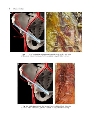 Fig. 11. (a,b) Variant type Ib showing two branches of the SCIA. [Color ﬁgure
can be viewed in the online issue, which is available at wileyonlinelibrary.com.]
Fig. 12. (a,b) Variant type II originates from the DCIA. [Color ﬁgure can
be viewed in the online issue, which is available at wileyonlinelibrary.com.]
8 Ghassemi et al.
 