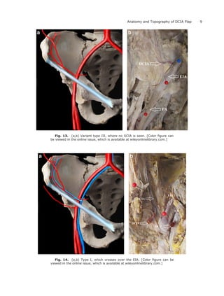 Fig. 13. (a,b) Variant type III, where no SCIA is seen. [Color ﬁgure can
be viewed in the online issue, which is available at wileyonlinelibrary.com.]
Fig. 14. (a,b) Type I, which crosses over the EIA. [Color ﬁgure can be
viewed in the online issue, which is available at wileyonlinelibrary.com.]
9Anatomy and Topography of DCIA Flap
 