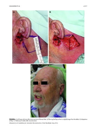 FIGURE 6. An 82-year-old man after tumor excision of the ear lobe. A, Planning the ﬂap so that it is slightly larger than the defect. B, Adaptation
of ﬂap. C, Follow-up 4 weeks after reconstruction.
Ghassemi et al. Guidelines for Auricular Reconstruction. J Oral Maxillofac Surg 2013.
GHASSEMI ET AL e241
 