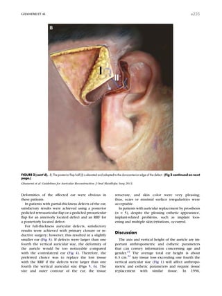 Deformities of the affected ear were obvious in
these patients.
In patients with partial-thickness defects of the ear,
satisfactory results were achieved using a posterior
pedicled retroauricular ﬂap or a pedicled preauricular
ﬂap for an anteriorly located defect and an RRF for
a posteriorly located defect.
For full-thickness auricular defects, satisfactory
results were achieved with primary closure or re-
ductive surgery; however, this resulted in a slightly
smaller ear (Fig 3). If defects were larger than one
fourth the vertical auricular size, the deformity of
the auricle would be too noticeable compared
with the contralateral ear (Fig 4). Therefore, the
preferred choice was to replace the lost tissue
with the RRF if the defects were larger than one
fourth the vertical auricular size (Figs 5, 6). The
size and outer contour of the ear, the tissue
structure, and skin color were very pleasing;
thus, scars or minimal surface irregularities were
acceptable.
In patients with auricular replacement by prosthesis
(n = 5), despite the pleasing esthetic appearance,
implant-related problems, such as implant loos-
ening and multiple skin irritations, occurred.
Discussion
The axis and vertical height of the auricle are im-
portant anthropometric and esthetic parameters
that can convey information concerning age and
gender.22
The average total ear height is about
6.3 cm.22
Any tissue loss exceeding one fourth the
vertical auricular size (Fig 1) will affect anthropo-
metric and esthetic parameters and require tissue
replacement with similar tissue. In 1956,
FIGURE 2 (cont’d). B, The posterior ﬂap half (I) is elevated and adapted to the dorsoanterior edge of the defect. (Fig 2 continued on next
page.)
Ghassemi et al. Guidelines for Auricular Reconstruction. J Oral Maxillofac Surg 2013.
GHASSEMI ET AL e235
 