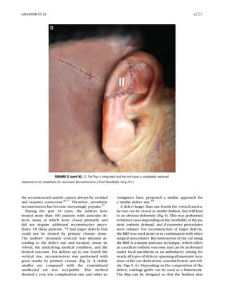 the reconstructed auricle cannot always be avoided
and requires correction.20,37
Therefore, prosthetic
reconstruction has become increasingly popular.37
During the past 10 years, the authors have
treated more than 100 patients with auricular de-
fects, many of which were closed primarily and
did not require additional reconstructive proce-
dures. Of these patients, 75 had larger defects that
could not be treated by primary closure alone.
The authors’ treatment concept was planned ac-
cording to the defect size and location, tissue in-
volved, the underlying medical condition, and the
desired outcome. For defects up to one fourth the
vertical size, reconstruction was performed with
good results by primary closure (Fig 3). A visibly
smaller ear compared with the contralateral
unaffected ear was acceptable. This method
showed a very low complication rate and other in-
vestigators have proposed a similar approach for
a similar defect size.18
A defect larger than one fourth the vertical auricu-
lar size can be closed in similar fashion, but will lead
to an obvious deformity (Fig 3). This was performed
in limited cases depending on the morbidity of the pa-
tient, esthetic demand, and if extensive procedures
were refused. For reconstruction of larger defects,
the RRF was used alone or in combination with other
surgical procedures. Reconstruction of the ear using
the RRF is a simple and easy technique, which offers
an excellent esthetic outcome and can be performed
under local anesthesia in an ambulatory setting for
nearly all types of defects, spanning all anatomic loca-
tions of the ear (helical rim, conchal bowel, and lob-
ule; Figs 5, 6). Depending on the composition of the
defect, cartilage grafts can be used as a framework.
The ﬂap can be designed so that the hairless skin
FIGURE 2 (cont’d). D, The ﬂap is integrated and the lost tissue is completely replaced.
Ghassemi et al. Guidelines for Auricular Reconstruction. J Oral Maxillofac Surg 2013.
GHASSEMI ET AL e237
 