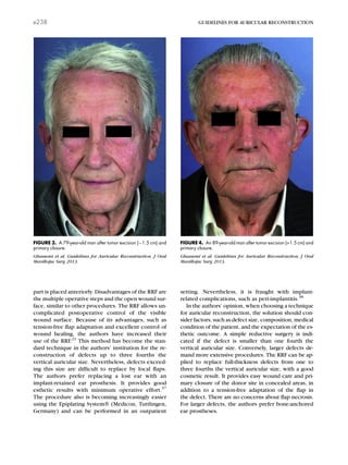 part is placed anteriorly. Disadvantages of the RRF are
the multiple operative steps and the open wound sur-
face, similar to other procedures. The RRF allows un-
complicated postoperative control of the visible
wound surface. Because of its advantages, such as
tension-free ﬂap adaptation and excellent control of
wound healing, the authors have increased their
use of the RRF.21
This method has become the stan-
dard technique in the authors’ institution for the re-
construction of defects up to three fourths the
vertical auricular size. Nevertheless, defects exceed-
ing this size are difﬁcult to replace by local ﬂaps.
The authors prefer replacing a lost ear with an
implant-retained ear prosthesis. It provides good
esthetic results with minimum operative effort.37
The procedure also is becoming increasingly easier
using the Epiplating SystemÒ (Medicon, Tuttlingen,
Germany) and can be performed in an outpatient
setting. Nevertheless, it is fraught with implant-
related complications, such as peri-implantitis.38
In the authors’ opinion, when choosing a technique
for auricular reconstruction, the solution should con-
sider factors, such as defect size, composition, medical
condition of the patient, and the expectation of the es-
thetic outcome. A simple reductive surgery is indi-
cated if the defect is smaller than one fourth the
vertical auricular size. Conversely, larger defects de-
mand more extensive procedures. The RRF can be ap-
plied to replace full-thickness defects from one to
three fourths the vertical auricular size, with a good
cosmetic result. It provides easy wound care and pri-
mary closure of the donor site in concealed areas, in
addition to a tension-free adaptation of the ﬂap in
the defect. There are no concerns about ﬂap necrosis.
For larger defects, the authors prefer bone-anchored
ear prostheses.
FIGURE 4. An 89-year-old man after tumor excision (>1.5 cm) and
primary closure.
Ghassemi et al. Guidelines for Auricular Reconstruction. J Oral
Maxillofac Surg 2013.
FIGURE 3. A 79-year-old man after tumor excision (1.5 cm) and
primary closure.
Ghassemi et al. Guidelines for Auricular Reconstruction. J Oral
Maxillofac Surg 2013.
e238 GUIDELINES FOR AURICULAR RECONSTRUCTION
 