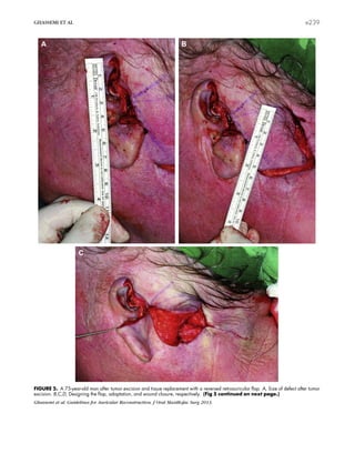 FIGURE 5. A 75-year-old man after tumor excision and tissue replacement with a reversed retroauricular ﬂap. A, Size of defect after tumor
excision. B,C,D, Designing the ﬂap, adaptation, and wound closure, respectively. (Fig 5 continued on next page.)
Ghassemi et al. Guidelines for Auricular Reconstruction. J Oral Maxillofac Surg 2013.
GHASSEMI ET AL e239
 