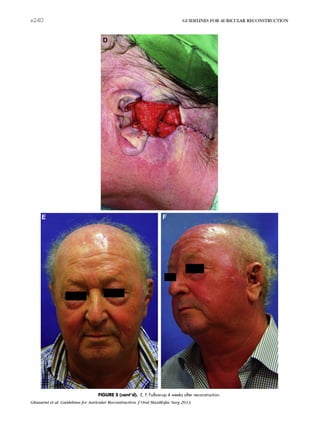FIGURE 5 (cont’d). E, F, Follow-up 4 weeks after reconstruction.
Ghassemi et al. Guidelines for Auricular Reconstruction. J Oral Maxillofac Surg 2013.
e240 GUIDELINES FOR AURICULAR RECONSTRUCTION
 