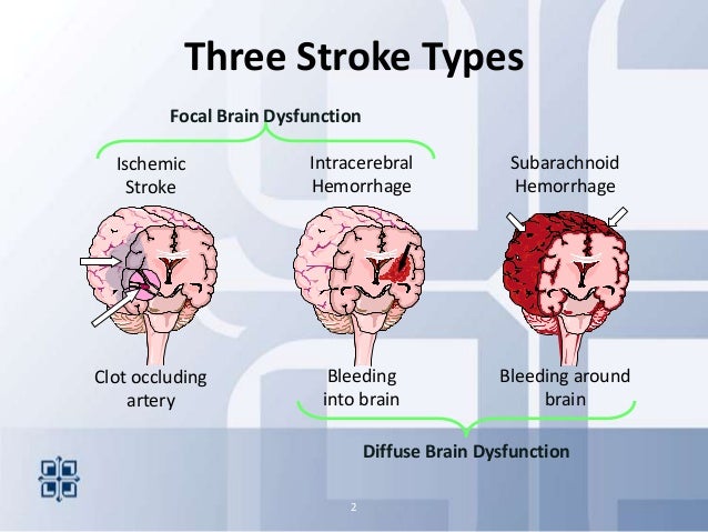 How Many Types Of Stroke How Many Types Of Stroke