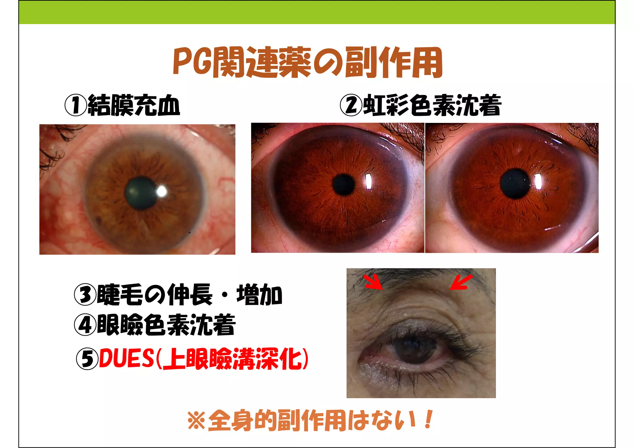 PG関連薬の副作用 
※全身的副作用はない！ 
①結膜充血 
③睫毛の伸長・増加 
④眼瞼色素沈着 
②虹彩色素沈着 
⑤DUES(上眼瞼溝深化) 
 