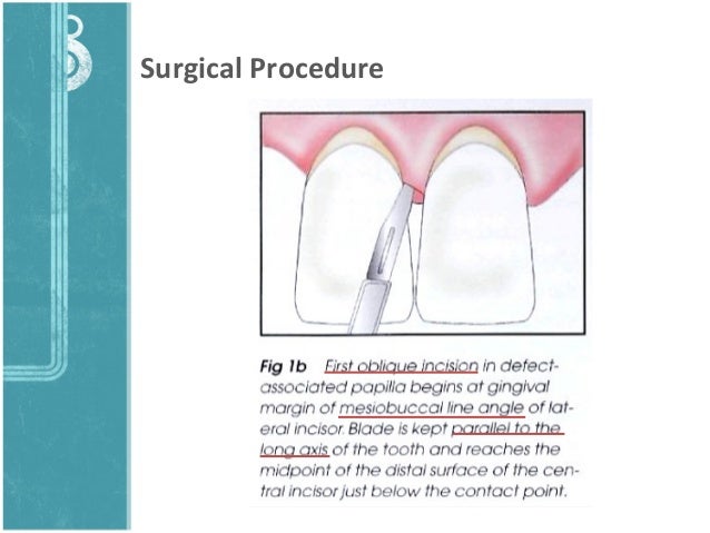 Simplified Papilla Preservation Technique