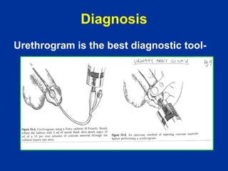 Steps Urethrogram urethrography | PPT