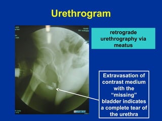 Retrograde Urethrogram Rupture urethrography | PPT