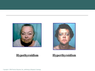 Hypothyroidism Hyperthyroidism 
Copyright © 2004 Pearson Education, Inc., publishing as Benjamin Cummings 
 