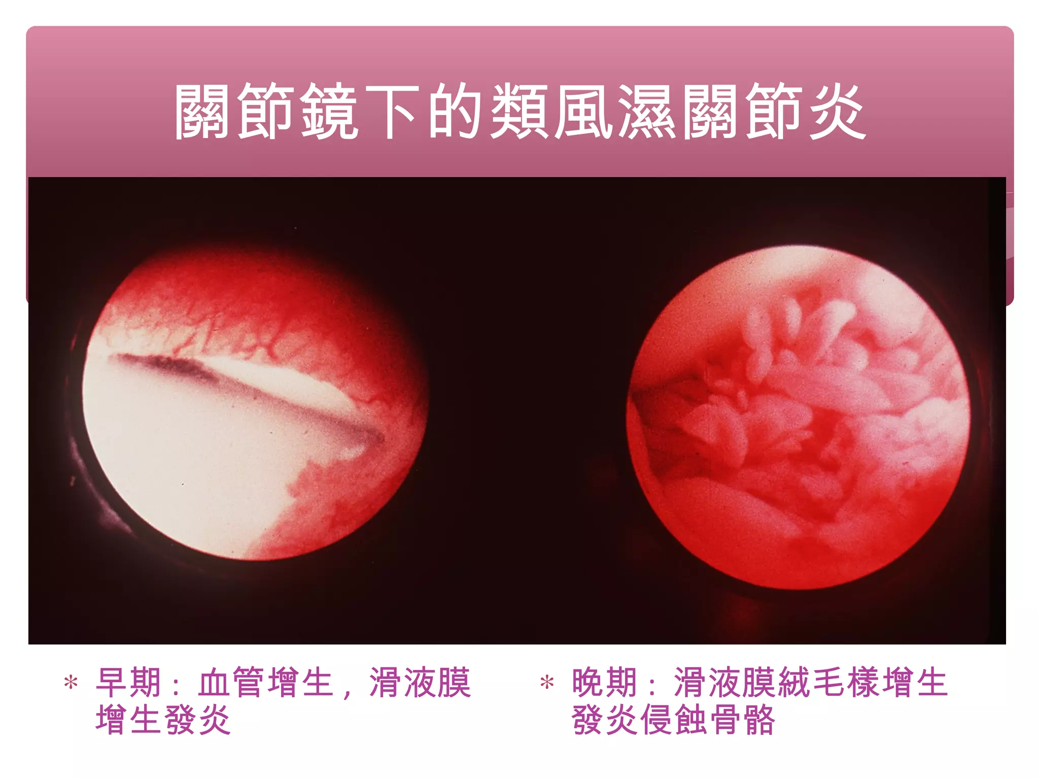 關節鏡下的類風濕關節炎
∗ 早期 : 血管增生 , 滑液膜
增生發炎
∗ 晚期 : 滑液膜絨毛樣增生
發炎侵蝕骨骼
 