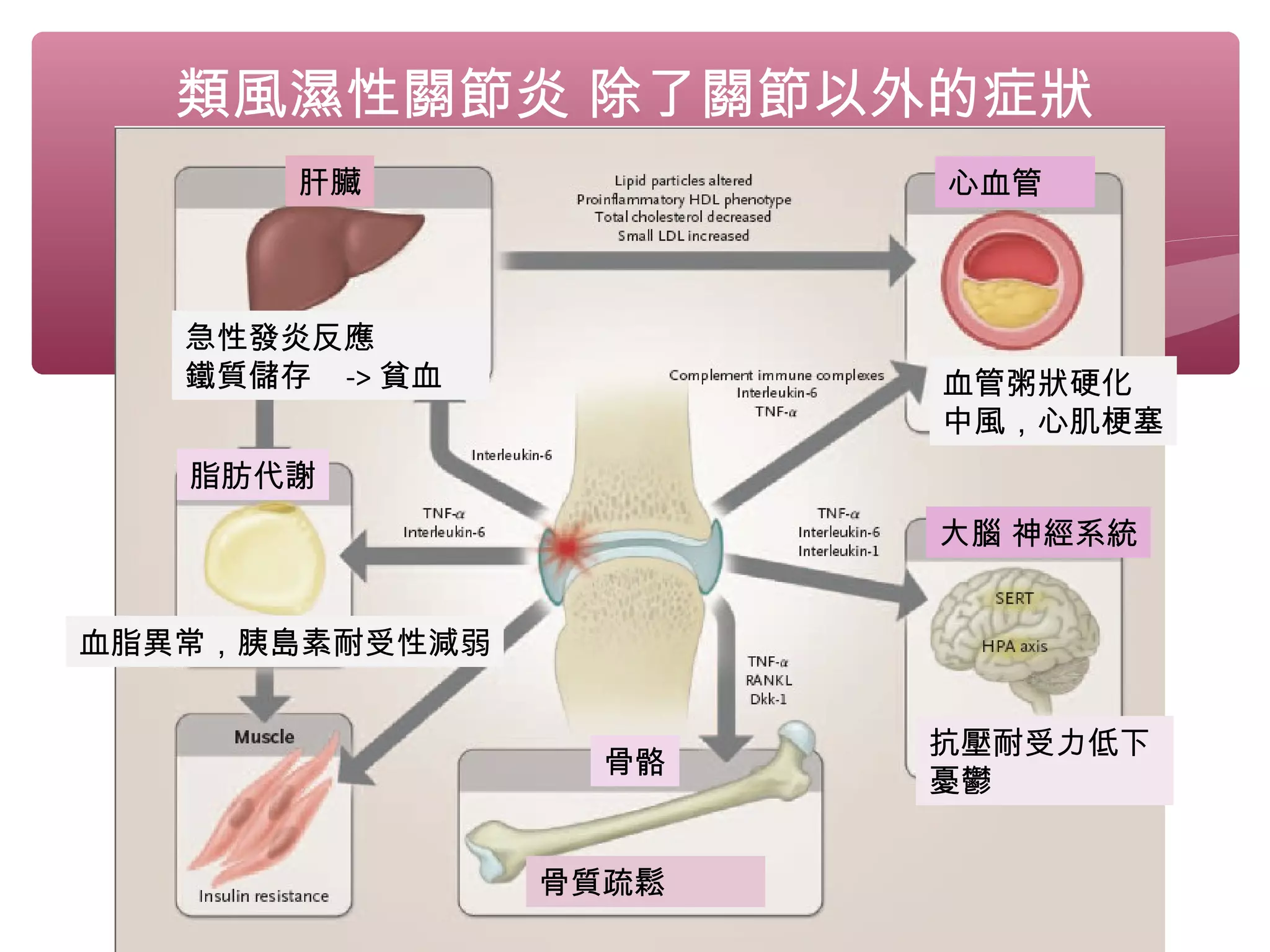 類風濕性關節炎 除了關節以外的症狀
心血管
血管粥狀硬化
中風，心肌梗塞
抗壓耐受力低下
憂鬱
大腦 神經系統
骨骼
骨質疏鬆
肝臟
脂肪代謝
急性發炎反應
鐵質儲存 -> 貧血
血脂異常，胰島素耐受性減弱
 