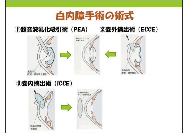 白内障と緑内障 病棟勉強会