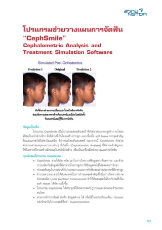 157
โปรแกรมช่วยวางแผนการจัดฟัน
“CephSmile”
Cephalometric Analysis and
Treatment Simulation Software
ข้อมูลเบื้องต้น :
	 โปรแกรม CephSmile เป็นโปรแกรมคอมพิวเตอร์ ที่ช่วยวาดรอยของรูปร่าง กะโหลก
ศีรษะใบหน้าด้านข้าง ทั้งที่ส่วนที่เป็นโครงสร้างกระดูก และเนื้อเยื่อ soft tissue จากจุดสำคัญ
ในแผ่นภาพรังสีเซฟาโลเมตริก ที่กำหนดโดยทันตแพทย์ นอกจากนี้ CephSmile ยังช่วย
คำนวณค่าของมุมและระยะต่างๆ ที่เกิดขึ้น (Cephalometric Analysis) ที่มีความสำคัญและ
ใช้วิเคราะห์โครงสร้างลักษณะใบหน้าด้านข้าง เพื่อเป็นเครื่องมือช่วยวางแผนการจัดฟัน
จุดเด่นของโปรแกรม CephSmile :
•	 CephSmile ช่วยให้ประหยัดเวลาในการวิเคราะห์ข้อมูลทางทันตกรรม และด้วย
ระบบจัดเก็บข้อมูลทำให้สะดวกในการดูประวัติข้อมูลคนไข้ได้ตลอดการรักษา
• 	ช่วยลดต้นทุนในการนำเข้าโปรแกรมวางแผนการจัดฟันของต่างประเทศที่มีราคาสูง
• 	อำนวยความสะดวกให้ทันตแพทย์ในการกำหนดจุดสำคัญที่ใช้ในการวิเคราะห์ภาพ
ด้วยเทคนิค Local Contrast Enhancement ทำให้ทันตแพทย์เห็นบริเวณที่เป็น
soft tissue ได้ชัดเจนยิ่งขึ้น
• 	โปรแกรม CephSmile ได้ประยุกต์ให้เหมาะสมกับรูปร่างและลักษณะศีรษะของ
คนไทย
• 	สามารถทำการพิมพ์ บันทึก ข้อมูลต่างๆ ได้ เพื่อใช้ในการเปรียบเทียบ ก่อนและ
หลังรักษาในโปรแกรมที่ชื่อว่า Superimposition
 