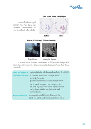 159
หน่วยงานเจ้าของผลงาน : ศูนย์เทคโนโลยีอิเล็กทรอนิกส์และคอมพิวเตอร์แห่งชาติ (NECTEC)
นักวิจัยเจ้าของโครงการ : ดร. จันทร์จิรา สินทนะโยธิน นายวิศรุต พลสิทธิ์
ดร. สุธี ผู้เจริญชนะชัย
ศูนย์เทคโนโลยีอิเล็กทรอนิกส์และคอมพิวเตอร์แห่งชาติ
	 ท.พ. นายสุรชัย เดชคุณากร ท.พ. วรรณา สุชาโต
ท.พ. นิวัติ อนุวงศ์นุเคราะห์ ท.พ.ดร. พีรพงศ์ สันติวงศ์
ภาควิชาทันตกรรมจัดฟัน คณะทันตแพทย์ศาสตร์
มหาวิทยาลัยมหิดล
สถานภาพของงานวิจัย : ถ่ายทอดสู่เชิงพาณิชย์ให้กับบริษัท ไบโอเมท จำกัด
	 ไปในปี พ.ศ. 2548 และมีการนำไปใช้แล้วจำนวน 15 ชุด
	 นอกจากนี้ ยังมีการประยุกต
ใชเทคนิค Thin Plate Spine และ
Geometric Transformation กับ
การคาดการณใบหนาหลังการดัดฟน
	 ดวยเทคนิค Local Contrast Enhancement ทำใหทันตแพทยกำหนดจุดสำคัญที่
ใชในการวิเคราะหภาพไดงายขึ้น เนื่องจากทันตแพทยจะเห็นสวนของบริเวณ Soft Tissue
ไดชัดเจนขึ้น
 