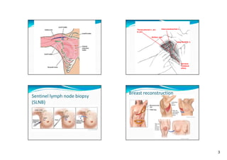 Thoracodorsal n. ,art.
& vein

Intercostobrachial n.

Axillary vein
y
Long thoracic n.

Serratus
collateral
artery

Sentinel lymph node biopsy 
(SLNB)

Breast reconstruction

3

 