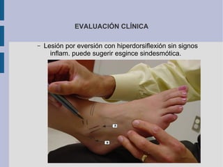 EVALUACIÓN CLÍNICA
– Lesión por eversión con hiperdorsiflexión sin signos
inflam. puede sugerir esgince sindesmótica.
 