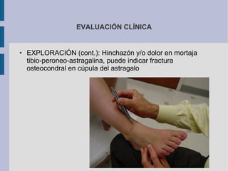 EVALUACIÓN CLÍNICA
● EXPLORACIÓN (cont.): Hinchazón y/o dolor en mortaja
tibio-peroneo-astragalina, puede indicar fractura
osteocondral en cúpula del astragalo
 