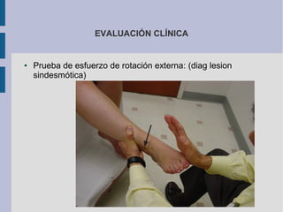 EVALUACIÓN CLÍNICA
● Prueba de esfuerzo de rotación externa: (diag lesion
sindesmótica)
 