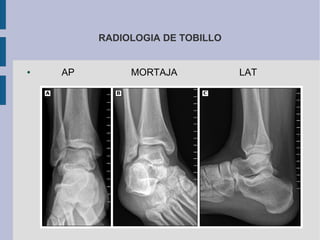 RADIOLOGIA DE TOBILLO
● AP MORTAJA LAT
 